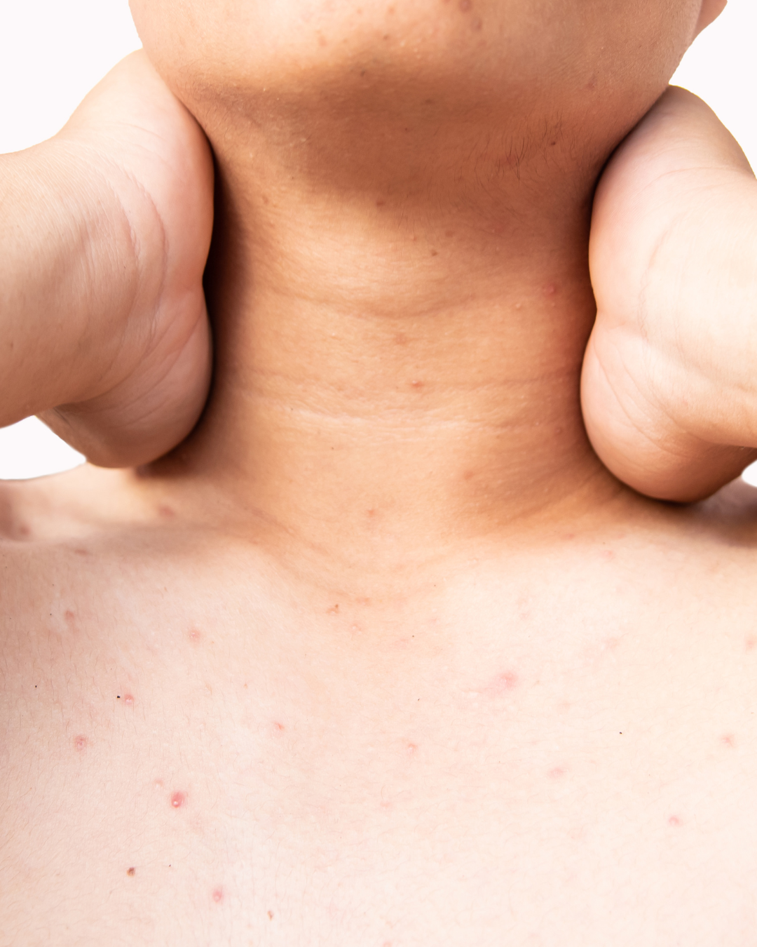 boutons sur le décolleté femme